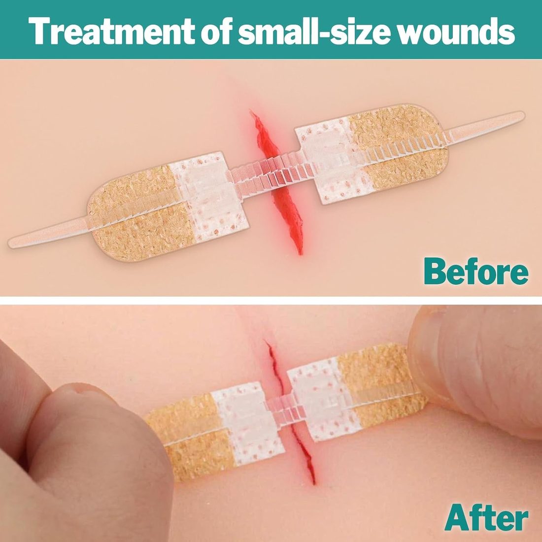 AZEN Zip-Style Wound Closure Strips · 12 Pack, view 4